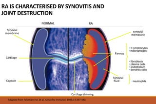 RA IS CHARACTERISED BY SYNOVITIS AND
JOINT DESTRUCTION
NORMAL RA
Synovial
membrane
Cartilage
Capsule
Synovial
fluid
Inflamed
synovial
membrane
Pannus
Major cell types:
• T lymphocytes
• macrophages
Minor cell types:
• fibroblasts
• plasma cells
• endothelium
• dendritic cells
Major cell type:
• neutrophils
Adapted from Feldmann M, et al. Annu Rev Immunol. 1996;14:397-440.
Cartilage thinning
 