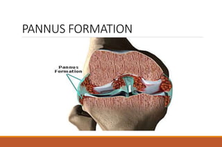 PANNUS FORMATION
 