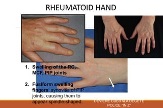 RHEUMATOID HAND
DEVIERE CUBITALA DEGETE
POLICE “IN Z”
1. Swelling of the RC,
MCF, PIP joints
2. Fusiform swelling
fingers: synovitis of PIP
joints, causing them to
appear spindle-shaped.
 