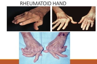 RHEUMATOID HAND
 