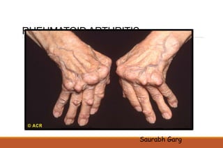 RHEUMATOID ARTHRITIS
Saurabh Garg
 