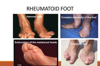 RHEUMATOID FOOT
Hammer toes Complex deformity of the foot
Subluxation of the metatarsal heads
Triangular foot
 