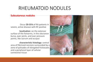 RHEUMATOID NODULES
Subcutaneus nodules
Occur 20-35% of RA patients in
severe, active disease with RF positive
localisation: on the extensor
surface of the forearms, in the olecranon
bursa, over joints, and over pressure
points, like sacrum and occiput
characteristic histology: central
area of fibrinoid necrosis surrounded by a
zone of palisades of elongated histiocytes
and a peripheral layer of cellular
connective tissue
 