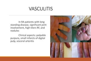 VASCULITIS
In RA patients with long
standing disease, significant joint
involvement, high titers RF, and
nodules
Clinical aspects: palpable
purpura, small infarcts of digital
pulp, visceral arteritis
 