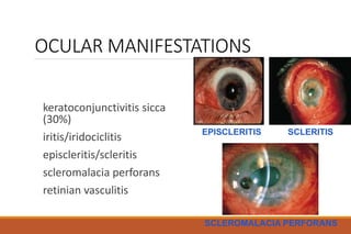 OCULAR MANIFESTATIONS
keratoconjunctivitis sicca
(30%)
iritis/iridociclitis
episcleritis/scleritis
scleromalacia perforans
retinian vasculitis
EPISCLERITIS SCLERITIS
SCLEROMALACIA PERFORANS
 