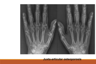 Juxta-articular osteoporosis
 
