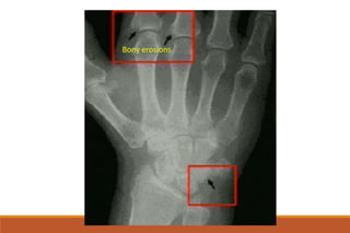 Bony erosions
 