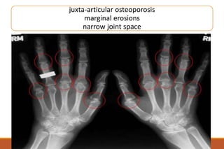 juxta-articular osteoporosis
marginal erosions
narrow joint space
 