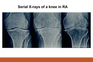 Serial X-rays of a knee in RA
 
