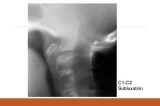 C1-C2
Subluxation
 