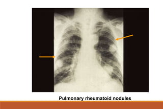 Pulmonary rheumatoid nodules
 