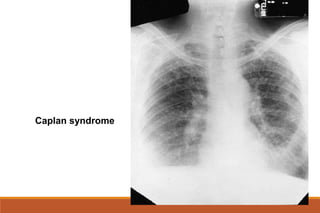Caplan syndrome
 