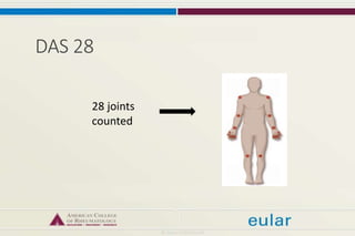 DAS 28
28 joints
counted
 