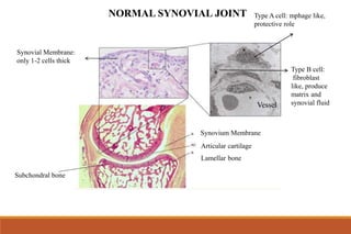 NORMAL SYNOVIAL JOINT
Articular cartilage
Synovium Membrane
Lamellar bone
Subchondral bone
Type A cell: mphage like,
protective role
Type B cell:
fibroblast
like, produce
matrix and
synovial fluid
Vessel
Synovial Membrane:
only 1-2 cells thick
 