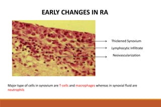 Thickened Synovium
Lymphocytic Infiltrate
Neovascularization
EARLY CHANGES IN RA
Major type of cells in synovium are T-cells and macrophages whereas in synovial fluid are
neutrophils
 