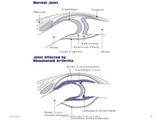 RHEUMATOID ARTHRITIS | PPTX