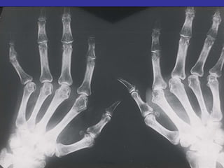 Periarticular Osteopenia
Joint Space Narrowing
Erosions
Mal-Alignment
 
