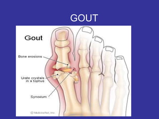 GOUT
 