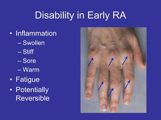 Disability in Early RA
• Inflammation
– Swollen
– Stiff
– Sore
– Warm
• Fatigue
• Potentially
Reversible
 