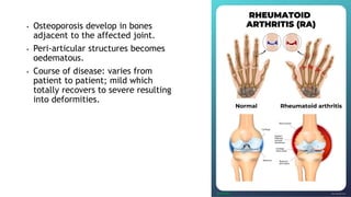 • Osteoporosis develop in bones
adjacent to the affected joint.
• Peri-articular structures becomes
oedematous.
• Course of disease: varies from
patient to patient; mild which
totally recovers to severe resulting
into deformities.
 