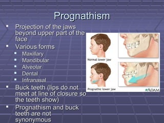 PPrrooggnnaatthhiissmm 
 PPrroojjeeccttiioonn ooff tthhee jjaawwss 
bbeeyyoonndd uuppppeerr ppaarrtt ooff tthhee 
ffaaccee 
 VVaarriioouuss ffoorrmmss 
 MMaaxxiillllaarryy 
 MMaannddiibbuullaarr 
 AAllvveeoollaarr 
 DDeennttaall 
 IInnffrraannaassaall 
 BBuucckk tteeeetthh ((lliippss ddoo nnoott 
mmeeeett aatt lliinnee ooff cclloossuurree ssoo 
tthhee tteeeetthh sshhooww)) 
 PPrrooggnnaatthhiissmm aanndd bbuucckk 
tteeeetthh aarree nnoott 
ssyynnoonnyymmoouuss 
