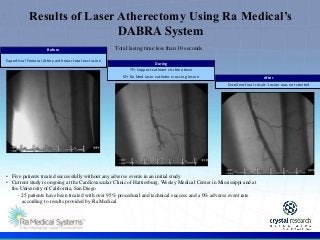 .
Results of Laser Atherectomy Using Ra Medical’s
DABRA System
Total lasing time less than 10 seconds
Superficial Femoral Artery with near total occlusion
Before
5Fr Ra Med laser catheter crossing lesion
7Fr Support catheter visible above
During
Excellent final result--lesion was not stented
After
• Five patients treated successfully without any adverse events in an initial study
• Current study is ongoing at the Cardiovascular Clinic of Hattiesburg, Wesley Medical Center in Mississippi and at
the University of California, San Diego
- 25 patients have been treated with over 95% procedural and technical success and a 0% adverse event rate
according to results provided by Ra Medical
 