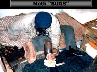 34
Meth “BUGS”
 
