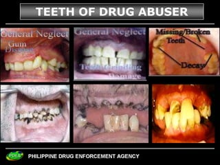 35
TEETH OF DRUG ABUSER
 