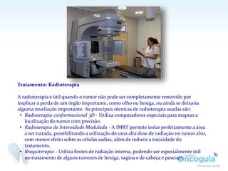 Tratamento: Radioterapia
A radioterapia é útil quando o tumor não pode ser completamente removido por
implicar a perda de um órgão importante, como olho ou bexiga, ou ainda se deixaria
alguma mutilação importante. As principais técnicas de radioterapia usadas são:
• Radioterapia conformacional 3D - Utiliza computadores especiais para mapear a
localização do tumor com precisão.
• Radioterapia de Intensidade Modulada - A IMRT permite isolar perfeitamente a área
a ser tratada, possibilitando a utilização de uma alta dose de radiação no tumor alvo,
com menor efeito sobre as células sadias, além de reduzir a toxicidade do
tratamento.
• Braquiterapia - Utiliza fontes de radiação interna, podendo ser especialmente útil
no tratamento de alguns tumores de bexiga, vagina e de cabeça e pescoço.
 