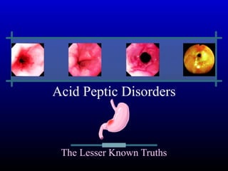 Acid Peptic Disorders The Lesser Known Truths 