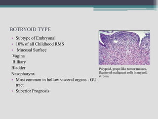 Orbital Rhabdomyosarcoma | PPTX