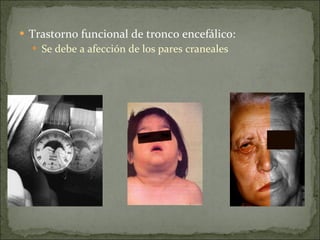 Trastorno funcional de tronco encefálico: Se debe a afección de los pares craneales 