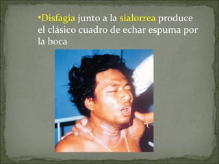 Disfagia  junto a la  sialorrea  produce el clásico cuadro de echar espuma por la boca  