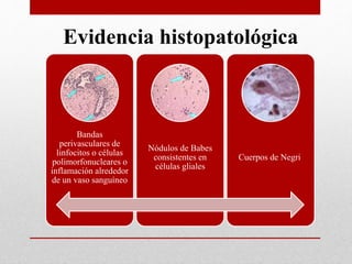 Evidencia histopatológica
Bandas
perivasculares de
linfocitos o células
polimorfonucleares o
inflamación alrededor
de un vaso sanguíneo
Nódulos de Babes
consistentes en
células gliales
Cuerpos de Negri
 