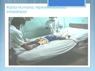 Rabia Humana: Hiperexitabilidad,
irritabilidad
 