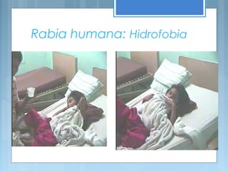 Rabia humana: Hidrofobia
 