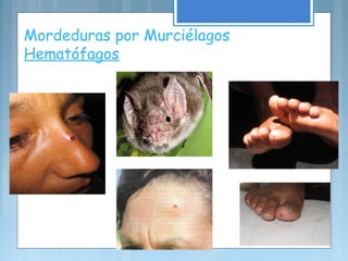 Mordeduras por Murciélagos
Hematófagos
 