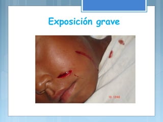 Exposición grave
 