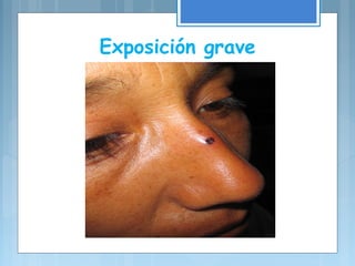 Exposición grave
 