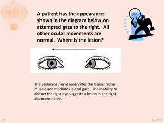 A patient has the appearance
shown in the diagram below on
attempted gaze to the right. All
other ocular movements are
normal. Where is the lesion?
The abducens nerve innervates the lateral rectus
muscle and mediates lateral gaze. The inability to
abduct the right eye suggests a lesion in the right
abducens nerve.
7/3/201520
 