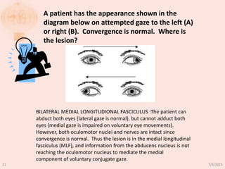 A patient has the appearance shown in the
diagram below on attempted gaze to the left (A)
or right (B). Convergence is normal. Where is
the lesion?
BILATERAL MEDIAL LONGITUDIONAL FASCICULUS :The patient can
abduct both eyes (lateral gaze is normal), but cannot adduct both
eyes (medial gaze is impaired on voluntary eye movements).
However, both oculomotor nuclei and nerves are intact since
convergence is normal. Thus the lesion is in the medial longitudinal
fasciculus (MLF), and information from the abducens nucleus is not
reaching the oculomotor nucleus to mediate the medial
component of voluntary conjugate gaze.
7/3/201521
 