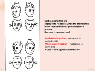 Cold caloric testing and
appropriate responses when the brainstem is
intact (top) and when a pontine lesion is
present
(bottom) is demonstrated.
Cold water irrigation—nystagmus to
opposite side
Warm water irrigation--- nystagmus to
same side
COWS----cold opposite,warm same
7/3/201522
 