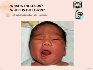 WHAT IS THE LESION?
WHERE IS THE LESION?
Left sided facial palsy, LMN type lesion
7/3/201544
 
