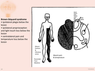Cortic
ospina
l
Tract
(moto
r)
Dorsal
Column
(Joint
Position
sense
light
touch)
Pyramidal
Tract
Weaknes
Absent
Position
&
Vibration
sense
Absent pain
& temperature
Brown-Séquard syndrome
• ipsilateral plegia below the
lesion
• ipsilateral proprioception
and light touch loss below the
lesion
• contralateral pain and
temperature loss below the
lesion
7/3/201564
 