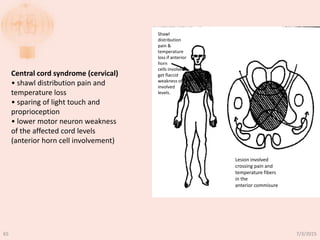 Central cord syndrome (cervical)
• shawl distribution pain and
temperature loss
• sparing of light touch and
proprioception
• lower motor neuron weakness
of the affected cord levels
(anterior horn cell involvement)
Shawl
distribution
pain &
temperature
loss if anterior
horn
cells involved
get flaccid
weakness of
involved
levels.
Lesion involved
crossing pain and
temperature fibers
in the
anterior commisure
7/3/201565
 