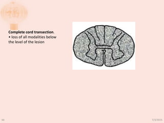 Complete cord transection.
• loss of all modalities below
the level of the lesion
7/3/201566
 