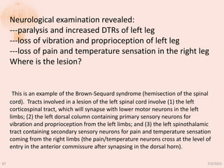 Neurological examination revealed:
---paralysis and increased DTRs of left leg
---loss of vibration and proprioception of left leg
---loss of pain and temperature sensation in the right leg
Where is the lesion?
This is an example of the Brown-Sequard syndrome (hemisection of the spinal
cord). Tracts involved in a lesion of the left spinal cord involve (1) the left
corticospinal tract, which will synapse with lower motor neurons in the left
limbs; (2) the left dorsal column containing primary sensory neurons for
vibration and proprioception from the left limbs; and (3) the left spinothalamic
tract containing secondary sensory neurons for pain and temperature sensation
coming from the right limbs (the pain/temperature neurons cross at the level of
entry in the anterior commissure after synapsing in the dorsal horn).
7/3/201567
 