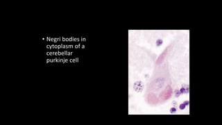• Negri bodies in
cytoplasm of a
cerebellar
purkinje cell
 
