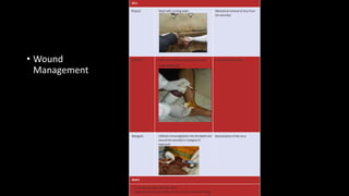 Do's
Physical Wash with running water Mechanical removal of virus from
the wound(s)
Chemical Wash the wound(s) with soap and water
Apply disinfectant
Inactivation of the virus
Biological Infiltrate immunoglobulin into the depth and
around the wound(s) in Category III
exposures
Neutralization of the virus
Dont's
Touch the wound(s) with bare hand
Apply irritants like soil, chilies, oil, lime, herbs, chalk, betel leaves,
• Wound
Management
 