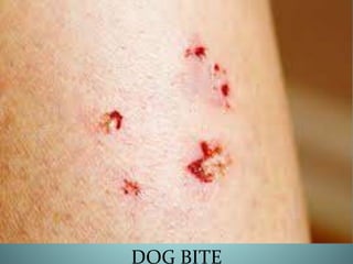 DOG BITE
 